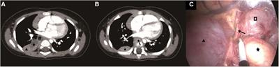 Simultaneous occurrence of extralobar pulmonary sequestration, esophageal duplication, and bronchogenic cysts in a Chinese child: a rare case report